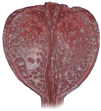 Sintomi prostatite cronica abatterica